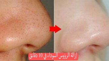 طريقة إزالة الرؤوس السوداء من الوجه في 10 دقائق فقط روعة ومش هتصدقي النتيجة