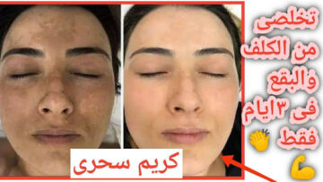 هتخلصي من كل مشاكلك.. كريم طبيعي يحتوي على علاج سحري للكلف خلال 3 أيام