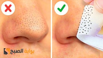  أفضل وصفات للتخلص من الرؤوس السوداء في المنزل