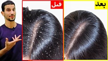 وصفة طبيعية للتخلص من قشرة الرأس نهائيا مع ضمان عدم رجوعها مرة اخرى