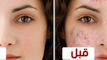 ماسك طبيعية لإزالة الحبوب للبشرة الدهنية من أول مرة بمكونات في المنزل