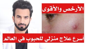 علاج حبوب البشرة الدهنية بوصفات طبيعية