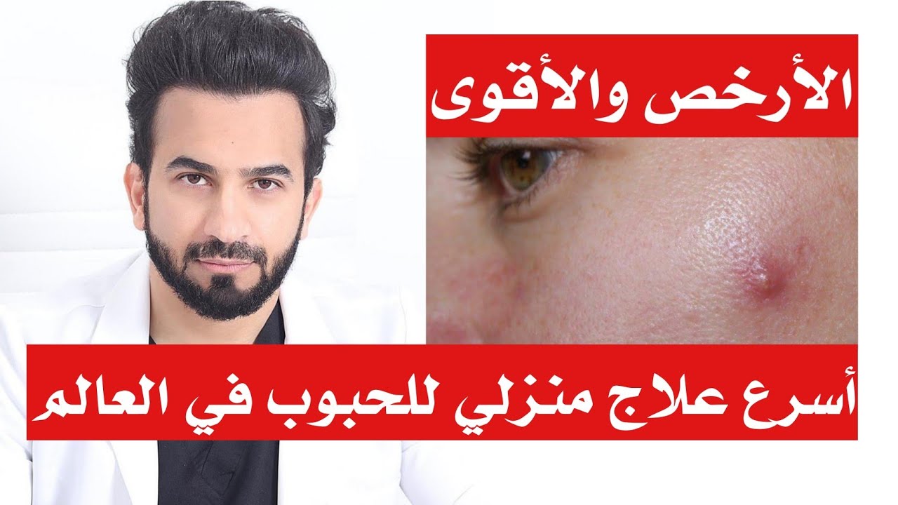 علاج حبوب البشرة الدهنية بوصفات طبيعية