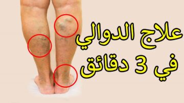 ألم الرجلين منغص عليك حياتك.. كوب من هذا المشروب علاج فعال للدوالي والأوردة العنكبوتية ينهيه تماما