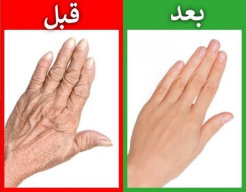 أفضل وصفة على الإطلاق لعلاج اليدين شديدة الجفاف والمتجعدة