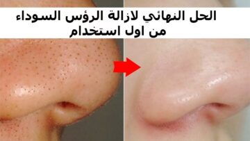 وصفة طبيعية لإزالة الرؤوس السوداء بسرعة وبدون استخدام أي مواد كيميائية