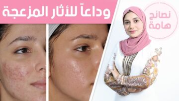 التخلص من آثار حب الشباب بكل سهولة وبطرق مجربة
