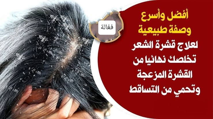 وصفة سحرية وفعالة للتخلص من القشرة بنتائج مذهلة بعد 3 أيام من الاستخدام! 5 وصفة سحرية وفعالة للتخلص من القشرة بنتائج مذهلة بعد 3 أيام من الاستخدام!