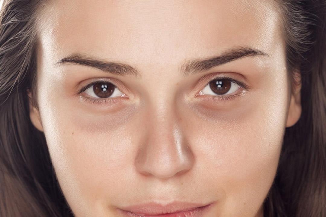طريقة طبيعية للتخلص من الهالات السوداء تحت العين والحصول علي مظهر صحي 5 طريقة طبيعية للتخلص من الهالات السوداء تحت العين والحصول علي مظهر صحي