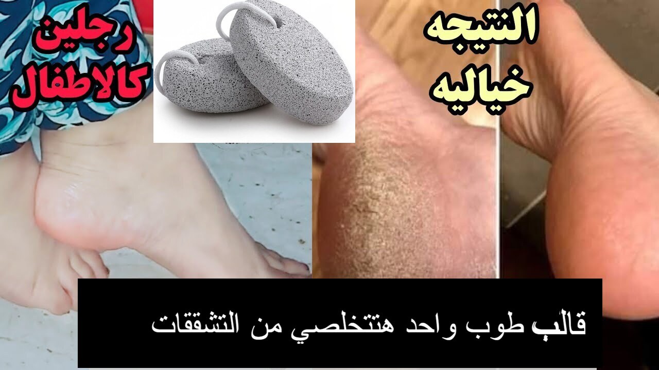 " بقالب حجر واحد " .. هتخلي رجليكي زي الأطفال منورة وناعمة حتى ولو فيها تشققات السنين 5 ” بقالب حجر واحد ” .. هتخلي رجليكي زي الأطفال منورة وناعمة حتى ولو فيها تشققات السنين