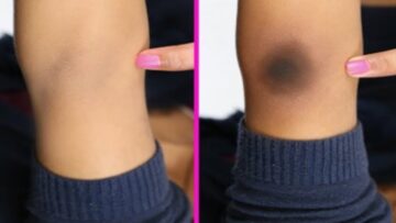 سيزول سواد السنين.. تبييض الأكواع والركب بوصفة طبيعية وفعالة 100%