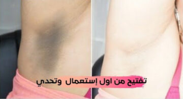 بياض الثلج.. وصفة صاروخية لتبييض الابطين والمناطق الحساسة وإزالة سواد 20 سنة هتبقي زي القشطة