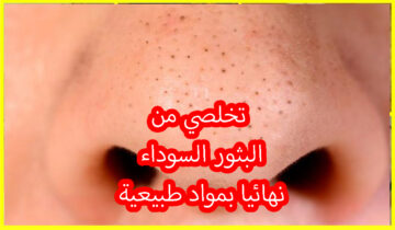 تخلصي من البثور السوداء في بشرتك بأسهل ماسك طبيعي