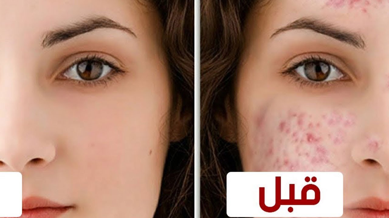 وصفات طبيعية للتخلص من حب الشباب والبثور بمواد أكثر فعالية 5 وصفات طبيعية للتخلص من حب الشباب والبثور بمواد أكثر فعالية