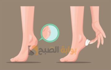 طريقة التخلص من تشققات القدمين والعناية بهم