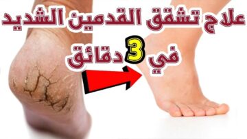 في نصف ساعة رجعي القدمين ناعمة حرير بمكون هيزيل التشققات والجلد الميت