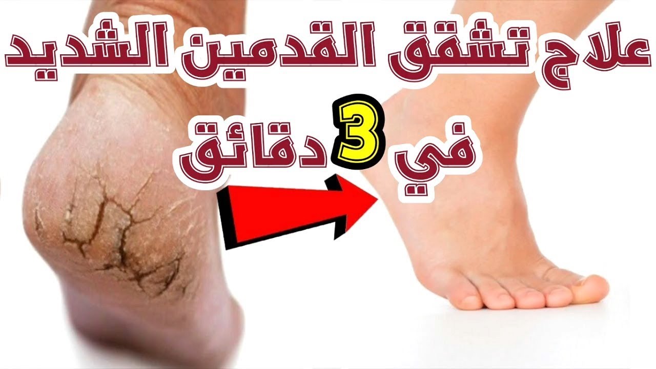 في نصف ساعة رجعي القدمين ناعمة حرير بمكون هيزيل التشققات والجلد الميت 5 في نصف ساعة رجعي القدمين ناعمة حرير بمكون هيزيل التشققات والجلد الميت