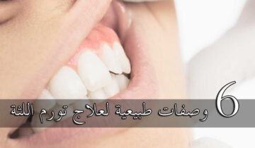 أسرع وصفة لعلاج التهاب اللثة الشديد وانتفاخها من أول أستخدام