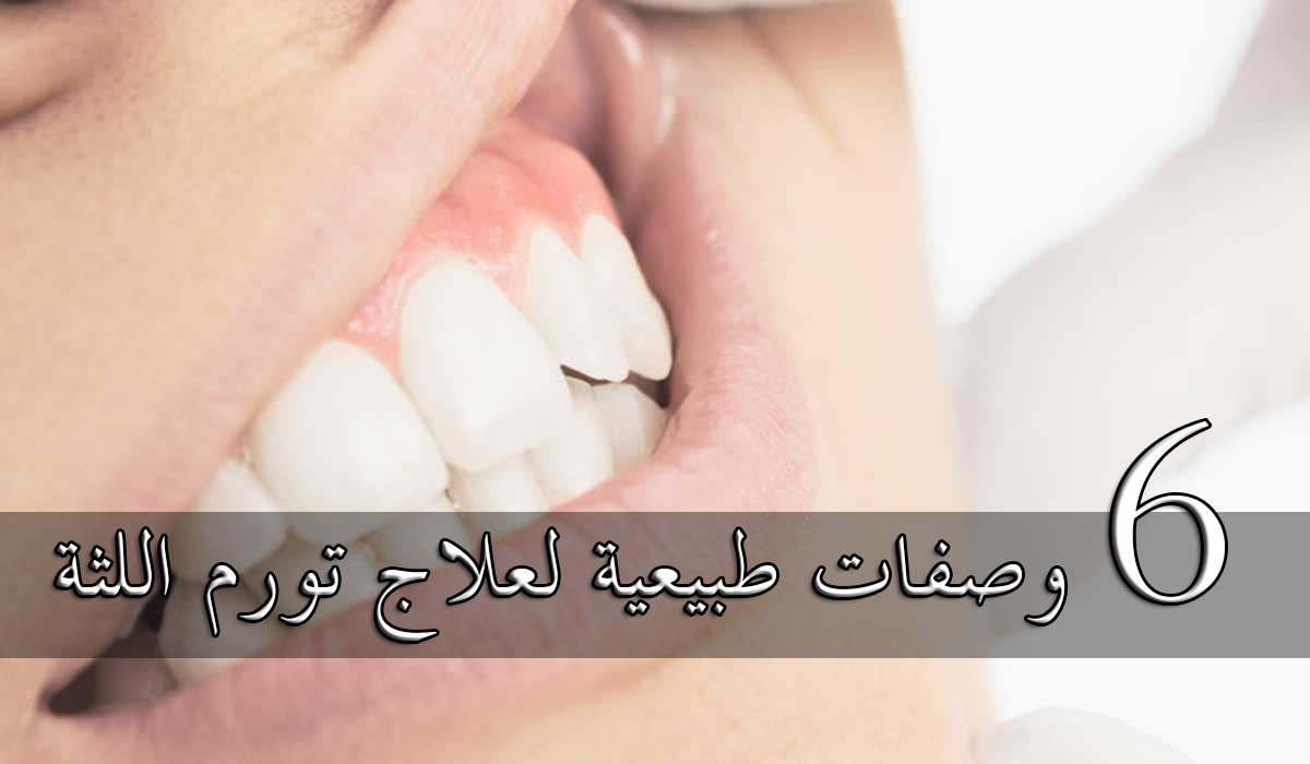 أسرع وصفة لعلاج التهاب اللثة الشديد وانتفاخها من أول أستخدام 5 أسرع وصفة لعلاج التهاب اللثة الشديد وانتفاخها من أول أستخدام