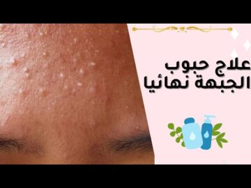 علاج الحبوب تحت الجلد في أسبوع واحد فقط بمكونات من مطبخك