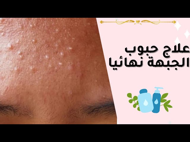 علاج الحبوب تحت الجلد في أسبوع واحد فقط بمكونات من مطبخك 5 علاج الحبوب تحت الجلد في أسبوع واحد فقط بمكونات من مطبخك