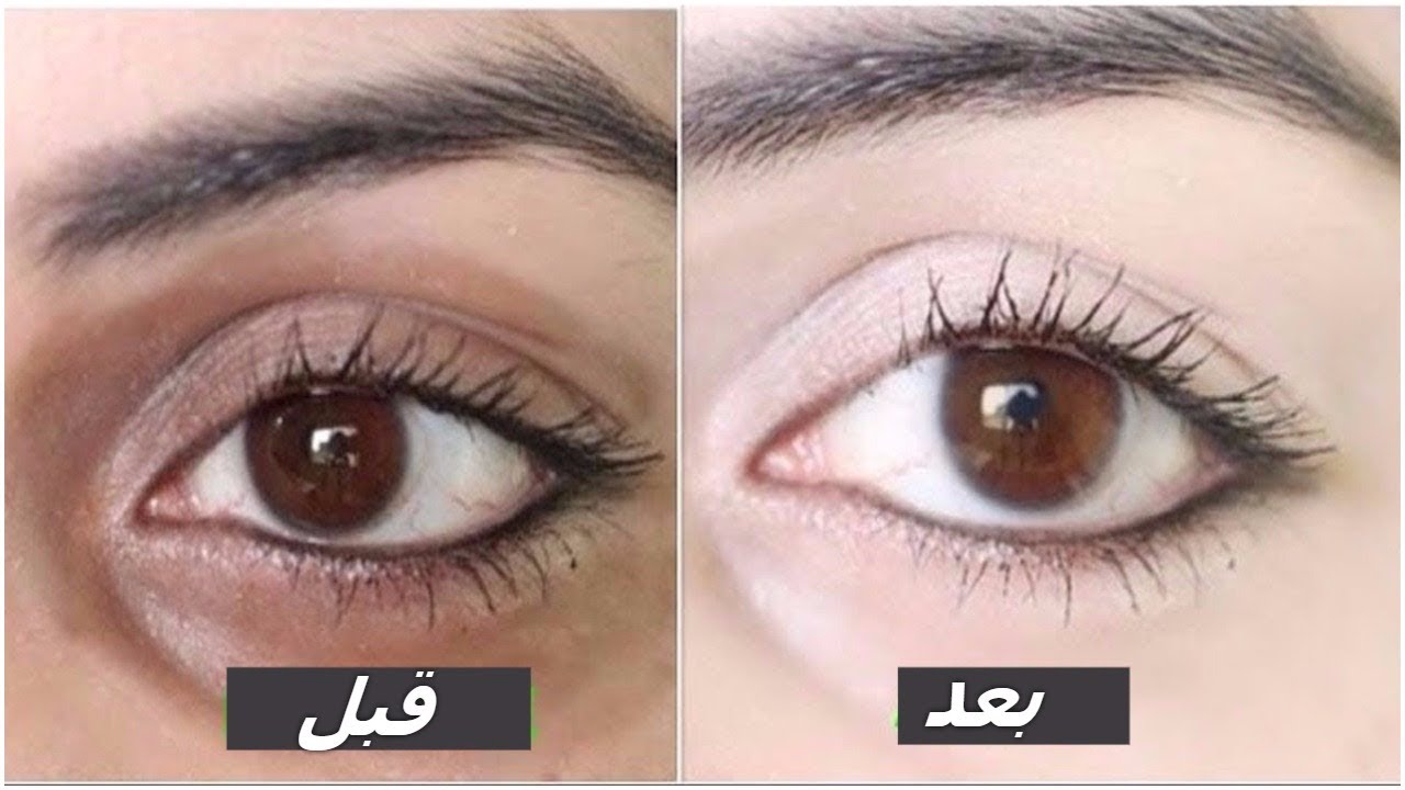 أهم طرق علاج الهالات السوداء الشديدة..وما هي أسباب حدوثها؟