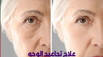 علاج تجاعيد الوجه