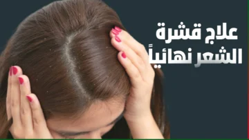 وصفة سحرية للتخلص من قشرة الشعر نهائيا بمكونات طبيعية هتختفي تماماً