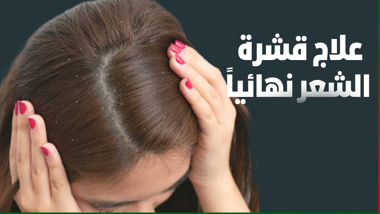 وصفة سحرية للتخلص من قشرة الشعر نهائيا بمكونات طبيعية هتختفي تماماً