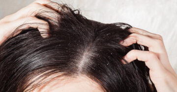 ما هي أسباب زيادة قشرة الشعر في الشتاء وكيفية التخلص منها؟