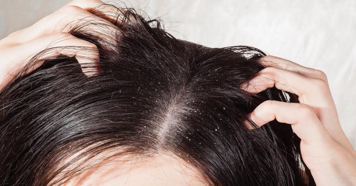 ما هي أسباب زيادة قشرة الشعر في الشتاء وكيفية التخلص منها؟
