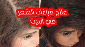 وصفات إنبات الشعر