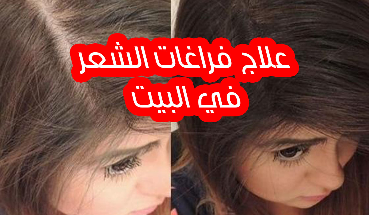 علاج فراغات الشعر وتكثيفه في البيت بدون أي مواد كيماوية