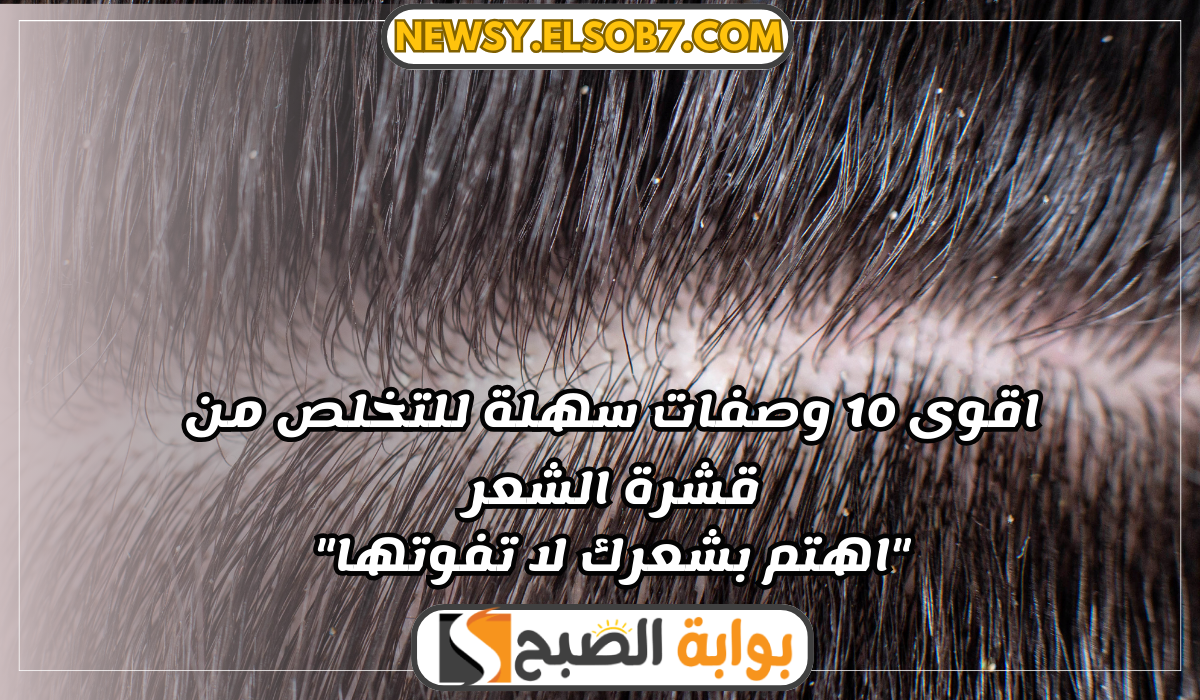 اقوى 10 وصفات سهلة للتخلص من قشرة الشعر “اهتم بشعرك لا تفوتها”