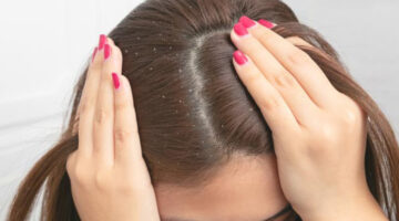 وصفات علاج قشرة الشعر