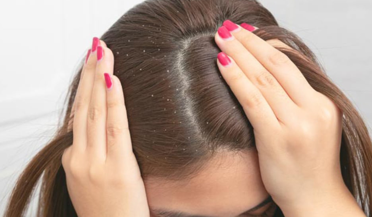 5 علاجات منزلية للتخلص من قشرة الشعر ولمعناه في وقت قصير