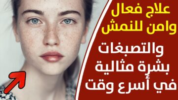 وصفات لإزالة النمش وتفتيح البشرة بمكونات طبيعية آمنة على بشرتك وغير مكلفة
