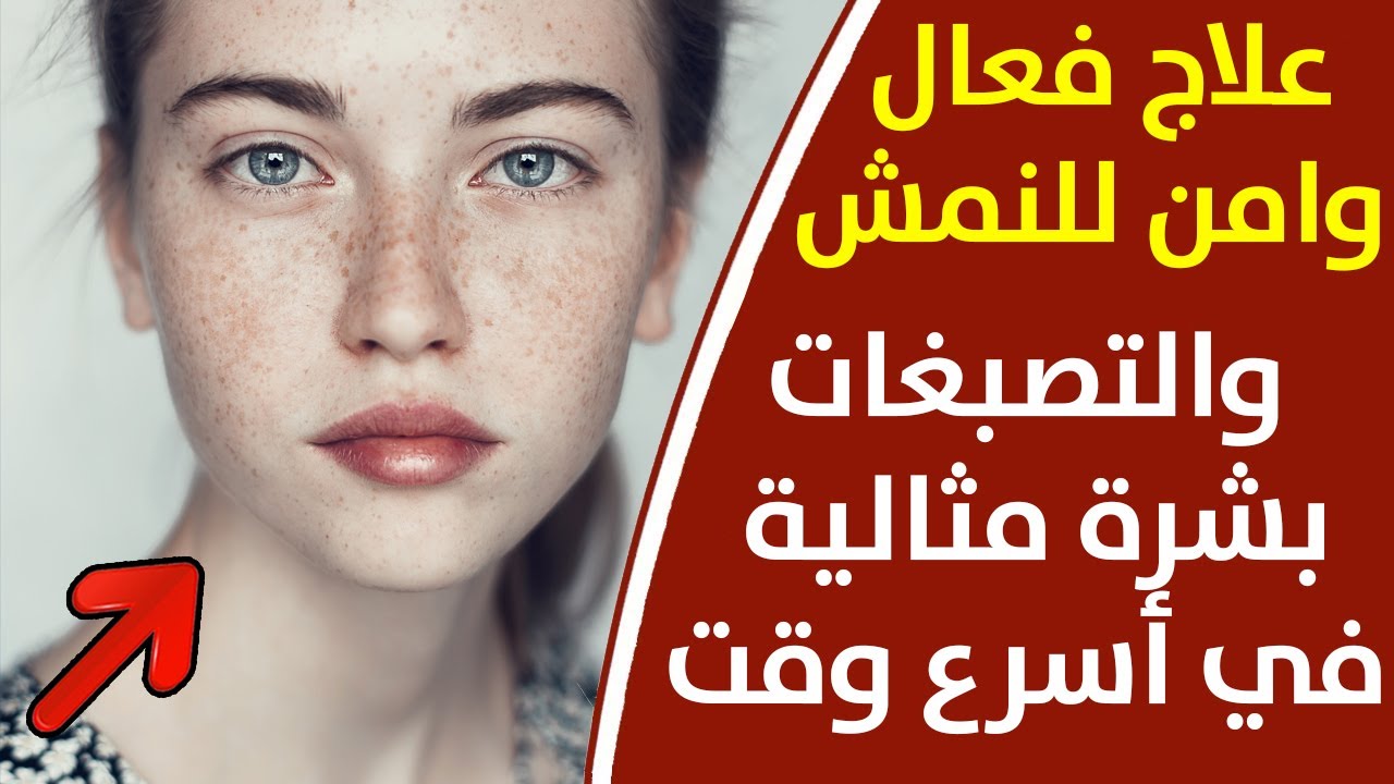 وصفات لإزالة النمش وتفتيح البشرة بمكونات طبيعية آمنة على بشرتك وغير مكلفة 5 وصفات لإزالة النمش وتفتيح البشرة بمكونات طبيعية آمنة على بشرتك وغير مكلفة