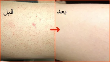 نهاية مشاكل جلد الوزة.. وصفات لعلاج جلد الوزة