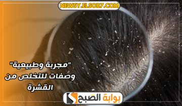 “مجربة وطبيعية” وصفات للتخلص من القشرة وداعا لتلف وتساقط الشعر