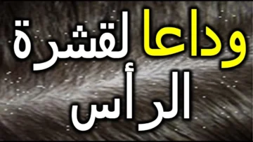 مستنية ايه اتخلصي من القشرة بسرعة بمواد طبيعية.. وصفات مجربة للتخلص من قشرة الشعر