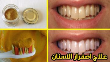 تمتعي بأسنان بيضة بدون جير وأصفرار بخلطة القرنفل هاتي معلقة منه وتعالي اقولك الطريقة أزاي