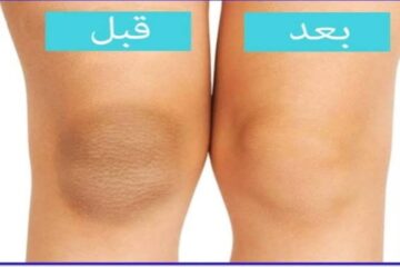 النتيجة رائعة … وصفة تبييض الركبتين مضمونة ومجربة متحسيش بالإحراج تاني