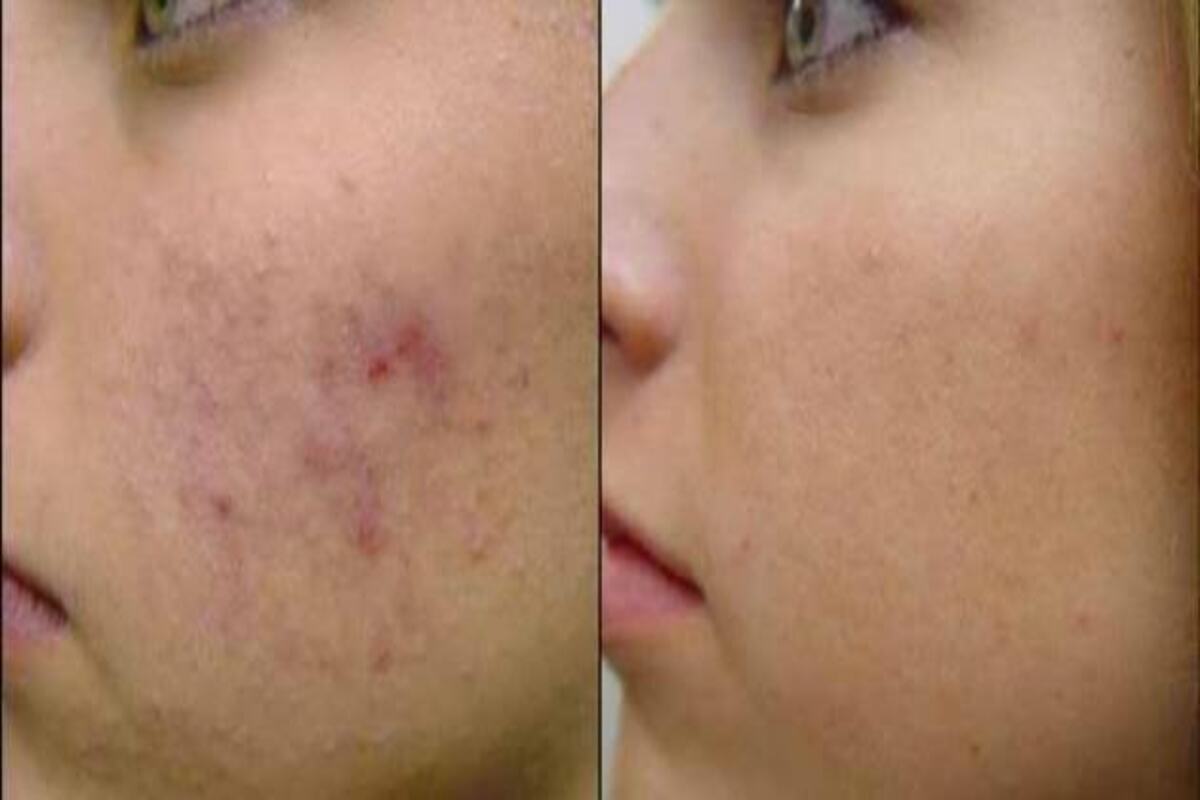 تخلصي منها سريعاً … وصفات للقضاء على آثار الحبوب في الوجه 5 تخلصي منها سريعاً … وصفات للقضاء على آثار الحبوب في الوجه
