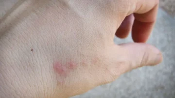 ما هو شكل قرص البق وما علامات انتشاره في منزلك؟