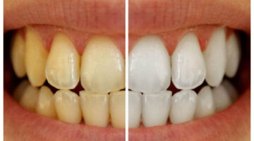 How to lighten teeth with charcoal