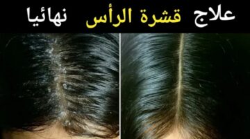 بمكون لا يخطر على بالك موجود في منزلك يقضي تماما على قشرة الشعر