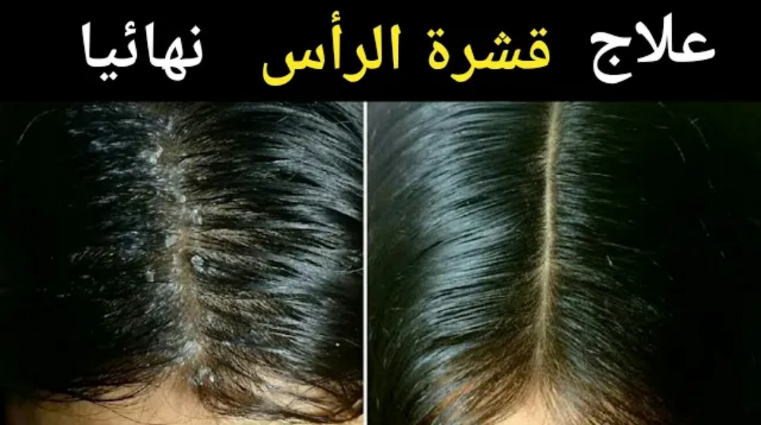 بمكون لا يخطر على بالك موجود في منزلك يقضي تماما على قشرة الشعر