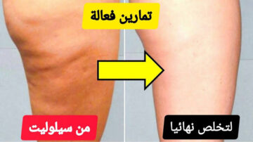 علاج السيلوليت والترهلات نهائيا في 14 يوم وتغيير الجلد 180 درجة