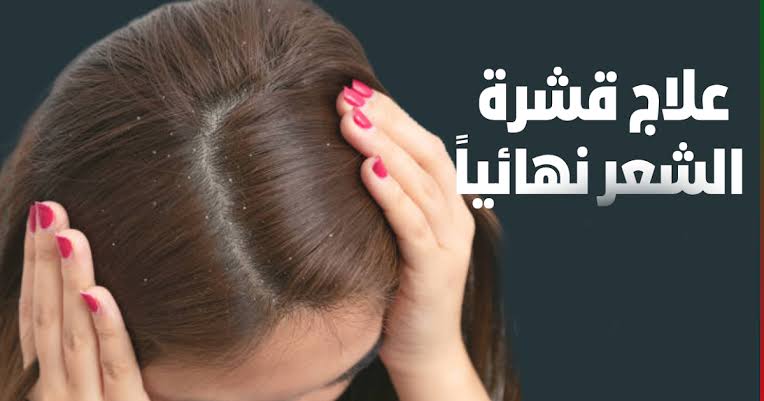 “وفر فلوس الشامبو“ كيفية التخلص من قشرة الشعر في المنزل بأسهل طريقة